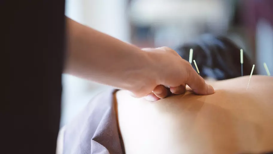 Person getting acupuncture