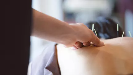 Person getting acupuncture